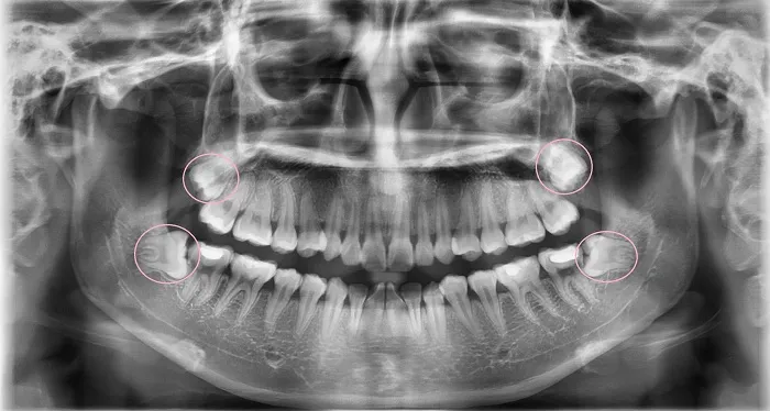 Chỉ định nhổ răng R18 - kiểm tra tình trạng răng tại Nha Khoa Kim