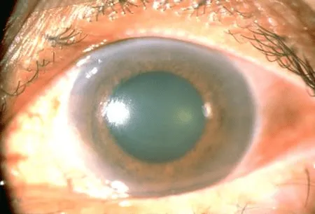 Glôcôm thường gây nên áp lực trong mắt thường gây tổn hại thần kinh thị giác