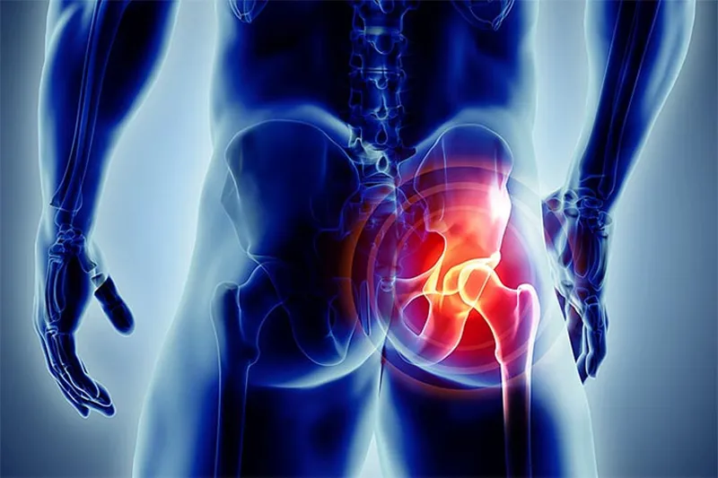 Hình ảnh minh họa về chấn thương vùng xương chậu